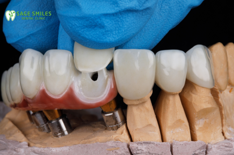 Dental Crown in Calagary NW