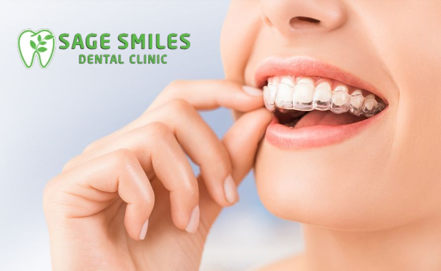 Best Invisalign Dentist in Calgary NW – Clear aligner treatment at Sage Smiles Dental Clinic for a confident and beautiful smile.