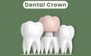 Dental crowns in Calgary NW for natural-looking tooth restoration