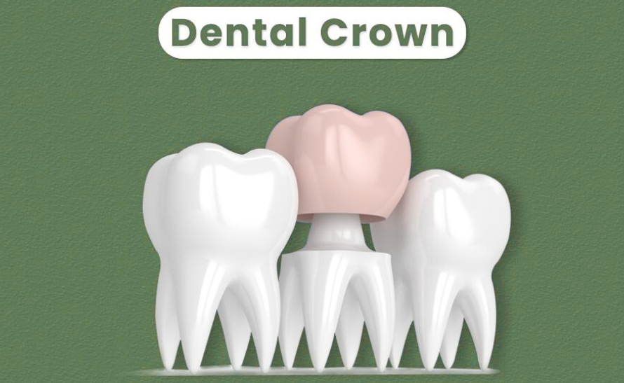 Dental crowns in Calgary NW for natural-looking tooth restoration